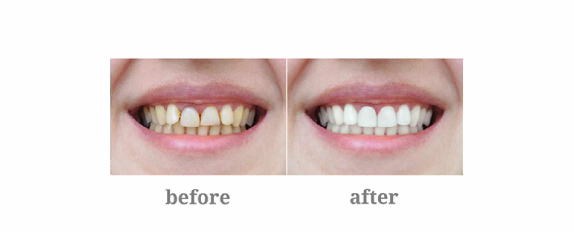 Anterior Teeth Reconstructions Treatment – Dr. Ernesto G. Diaz DDS